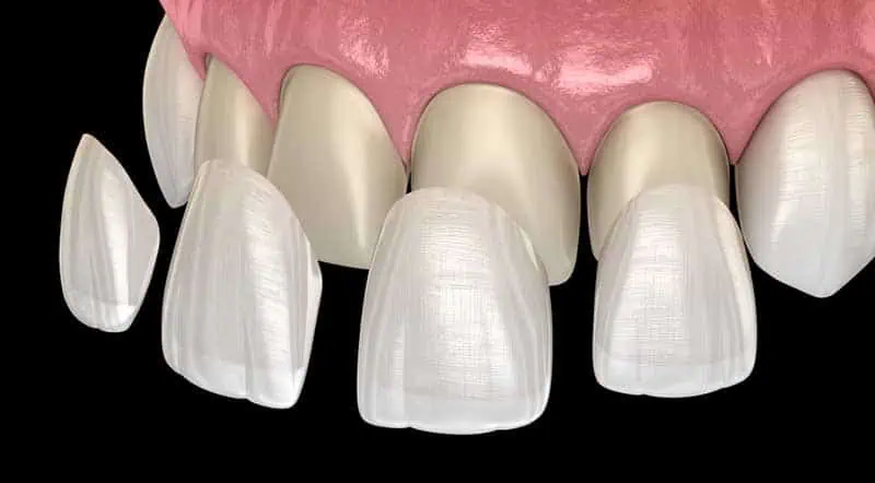 Dental implants