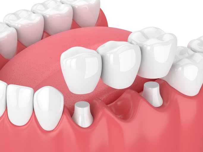 3d render of jaw with dental bridge Oldham clinic