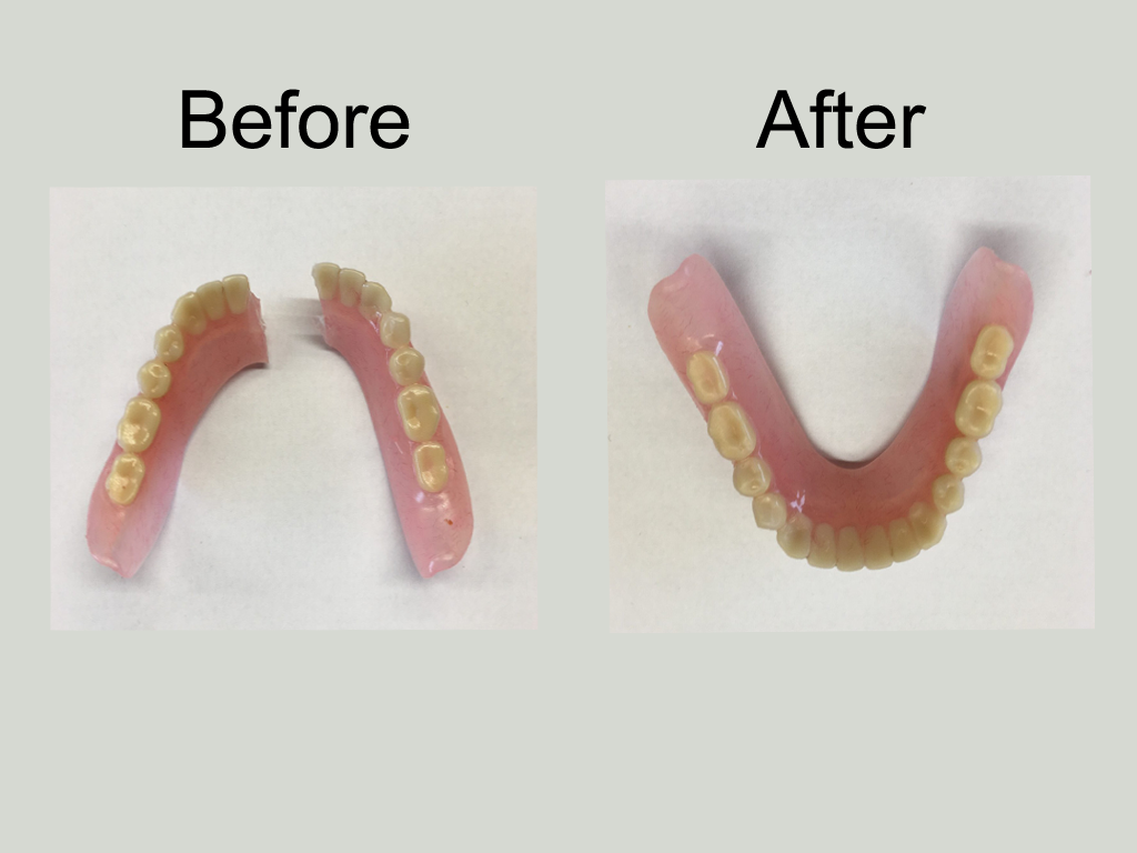 before and after broken denture repair