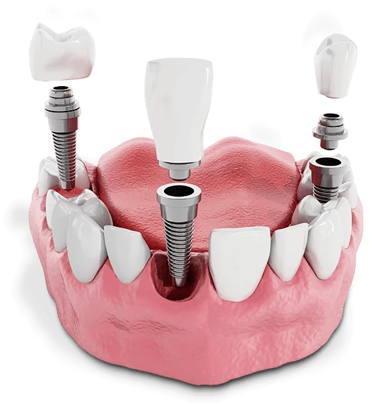 Multiple dental implants oldham